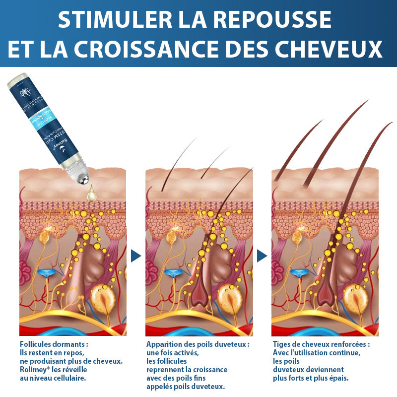 🇨🇦🍁Développé par des trichologues: 𝐑𝐨𝐥𝐢𝐦𝐞𝐲® 𝐒𝐓𝐄𝐌 𝐂𝐞𝐥𝐥 𝐇𝐚𝐢𝐫 𝐂𝐲𝐜𝐥𝐞 𝐑𝐨𝐥𝐥𝐞𝐫 – Stoppe instantanément la perte de cheveux et favorise une repousse réelle(🔥JUSQU’À 80% DE RABAIS)