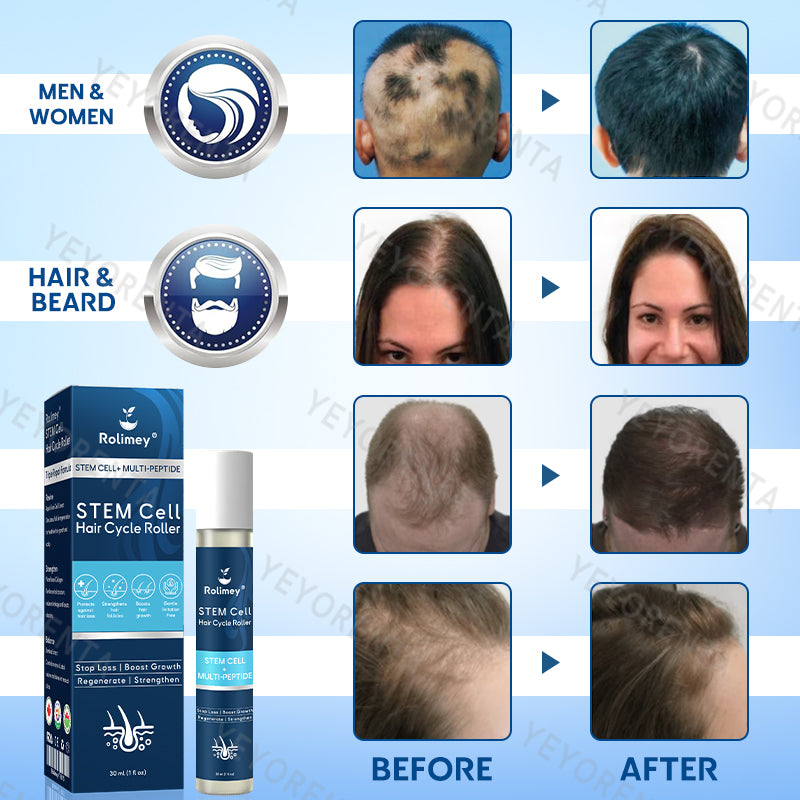 ✅CA Owned and Operated: 𝙍𝙤𝙡𝙞𝙢𝙚𝙮® 𝙎𝙏𝙀𝙈 𝘾𝙚𝙡𝙡 𝙃𝙖𝙞𝙧 𝘾𝙮𝙘𝙡𝙚 𝙍𝙤𝙡𝙡𝙚𝙧 (Male pattern baldness · Thinning hair · Receding hairline · Postpartum hair loss · Stress-related shedding · Ageing hair · Scalp discomfort)
