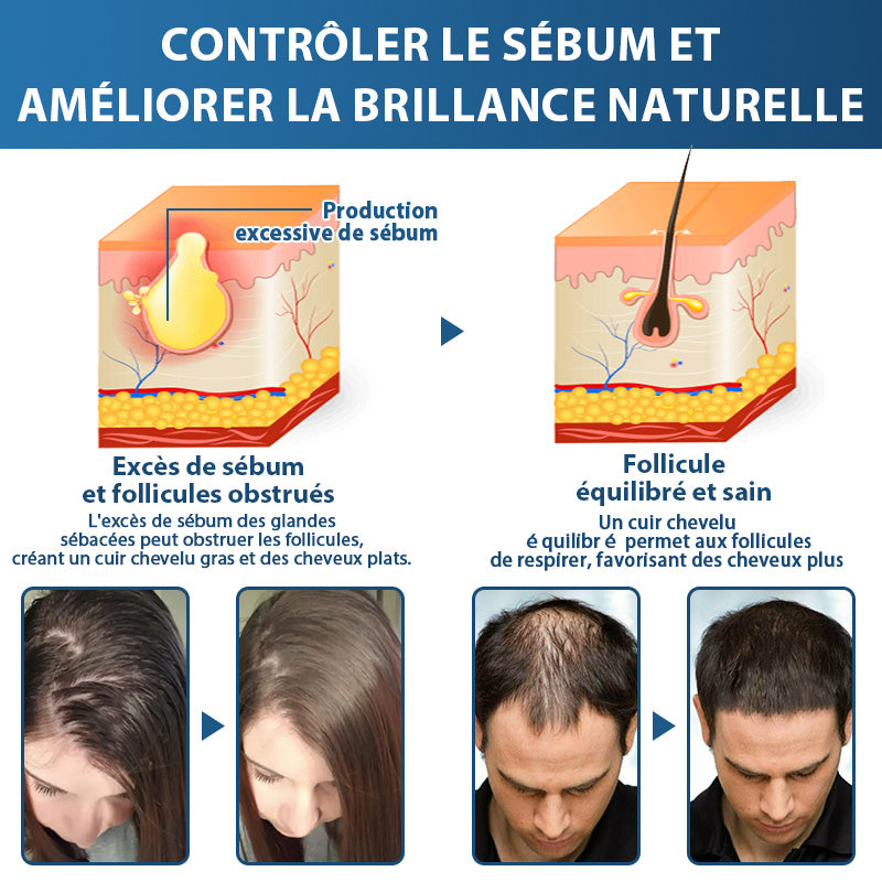 🇨🇦🍁Développé par des trichologues: 𝐑𝐨𝐥𝐢𝐦𝐞𝐲® 𝐒𝐓𝐄𝐌 𝐂𝐞𝐥𝐥 𝐇𝐚𝐢𝐫 𝐂𝐲𝐜𝐥𝐞 𝐑𝐨𝐥𝐥𝐞𝐫 – Stoppe instantanément la perte de cheveux et favorise une repousse réelle(🔥JUSQU’À 80% DE RABAIS)
